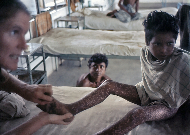 1975 Bangladesh. Scarring; T Ward
