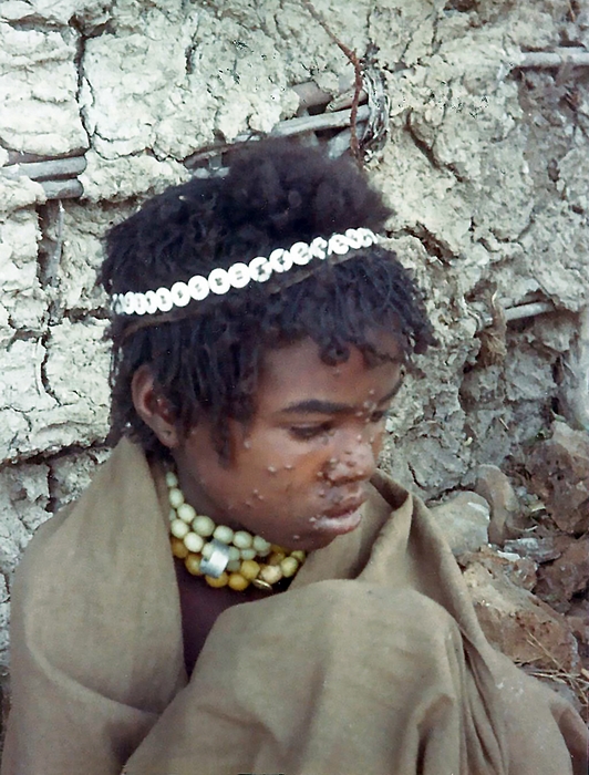 1976 Ethiopia. Child with smallpox