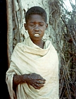 1976 Ethiopia. Child with smallpox