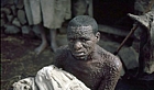 1972 Ethiopia. Smallpox case