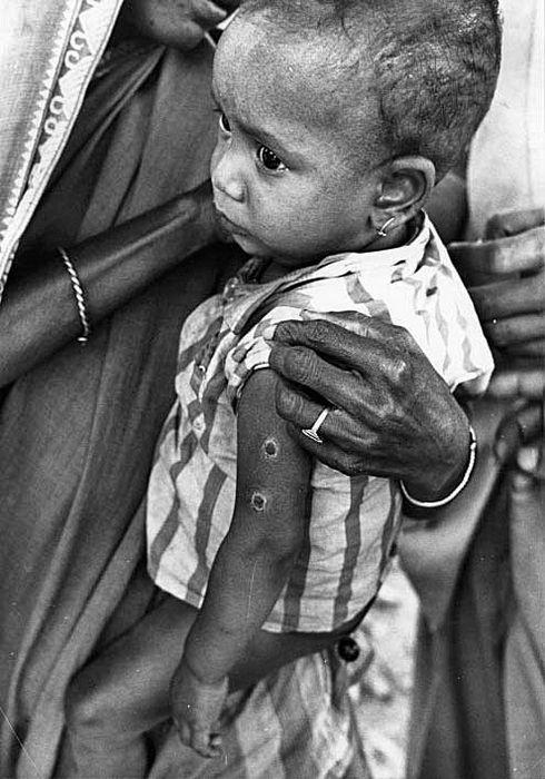 1965 Bangladesh. Child with two rotary lancet sites 1965 Bangladesh. Child with two rotary lancet sites