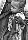 1965 Bangladesh. Child with two rotary lancet sites